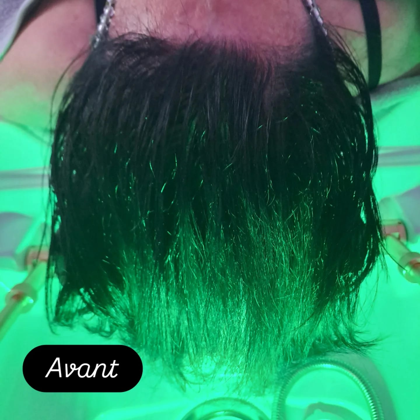 Avant le soin